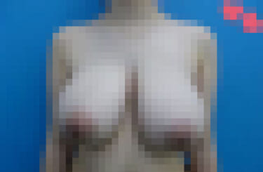 【悲報】21歳女子大生、手術で自慢のMカップおっぱいを手放してしまう（画像あり）